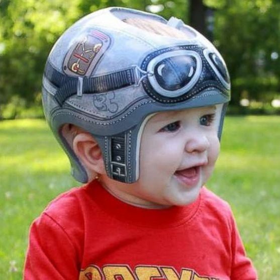 toddler with helmet on - plagiocephaly concept